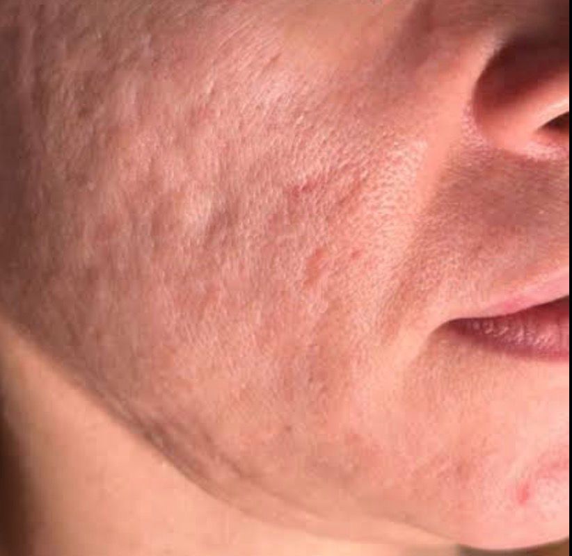 acne quando procurar médico