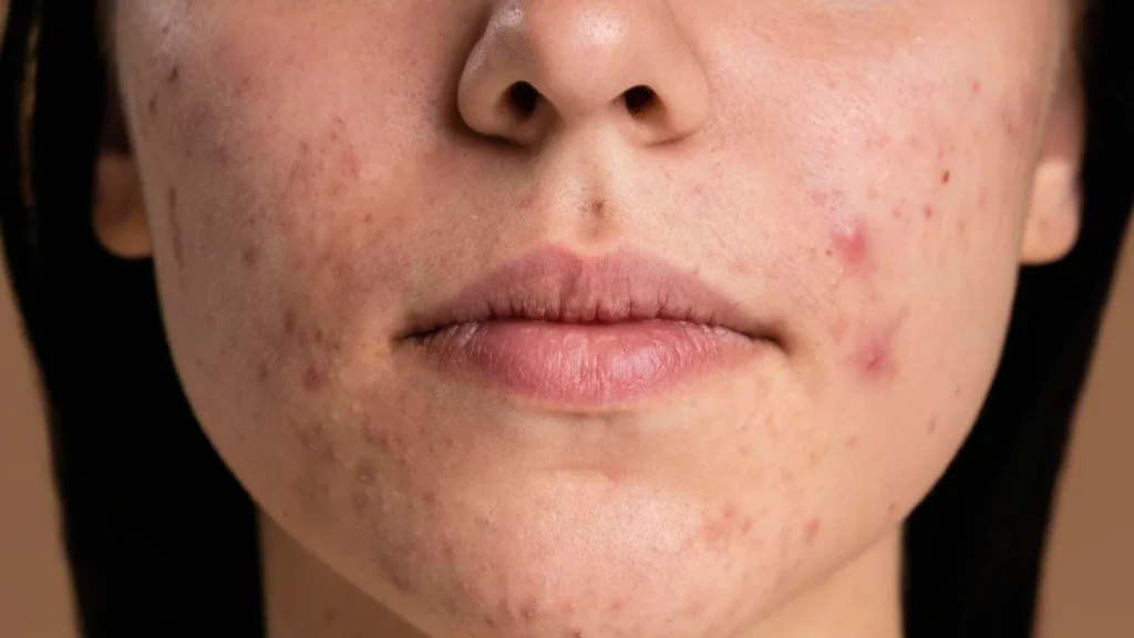 acne quando procurar médico