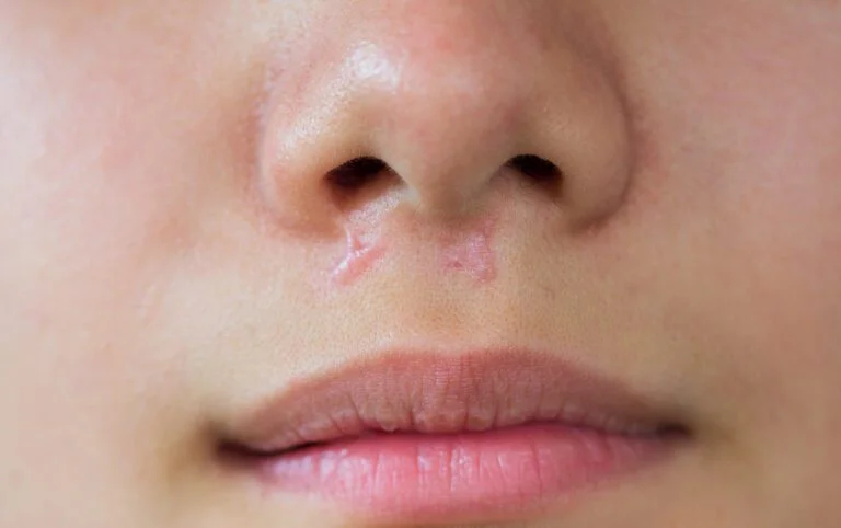 acne quando procurar médico