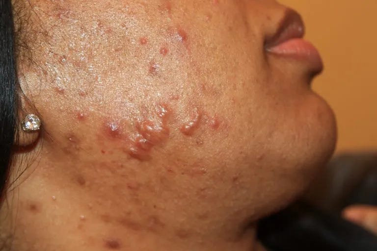 acne quando procurar médico